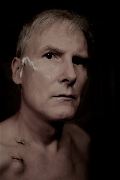 July 2024, They inserted a port, the tube going to my heart caused a blood clot in my heart